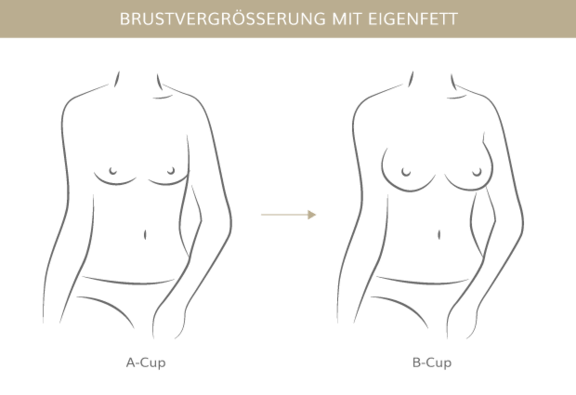 Brustvergrößerung mit Eigenfett, Plastische & Ästhetische Chirurgie in Stuttgart, Dr. Schumacher