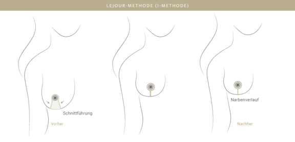 Bruststraffung Lejour-Methode, Plastische & Ästhetische Chirurgie in Stuttgart, Dr. Schumacher