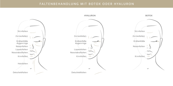 Faltenbehandlung mit Botox oder Hyaluron, Plastische & Ästhetische Chirurgie in Stuttgart, Dr. Schumacher