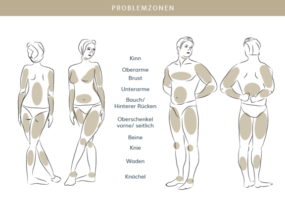 Fettabsaugung, Plastische & Ästhetische Chirurgie in Stuttgart, Dr. Schumacher