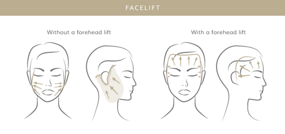 Facelift, Plastische & Ästhetische Chirurgie in Stuttgart, Dr. Schumacher