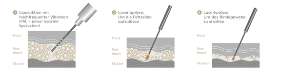 Lipödem OP, Plastische & Ästhetische Chirurgie in Stuttgart, Dr. Schumacher