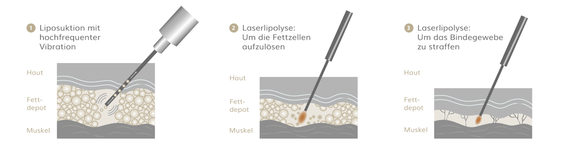 Lipödem OP, Plastische & Ästhetische Chirurgie in Stuttgart, Dr. Schumacher