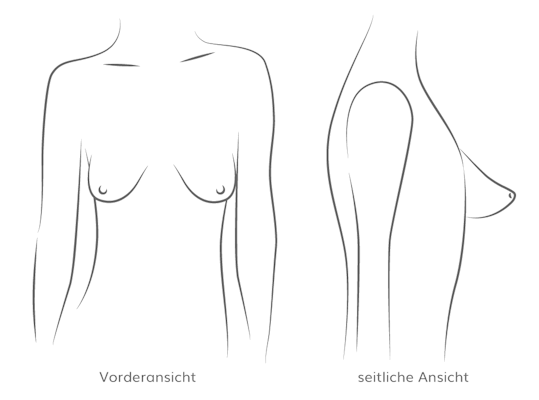 Tubuläre Brust, Plastische & Ästhetische Chirurgie in Stuttgart, Dr. Schumacher